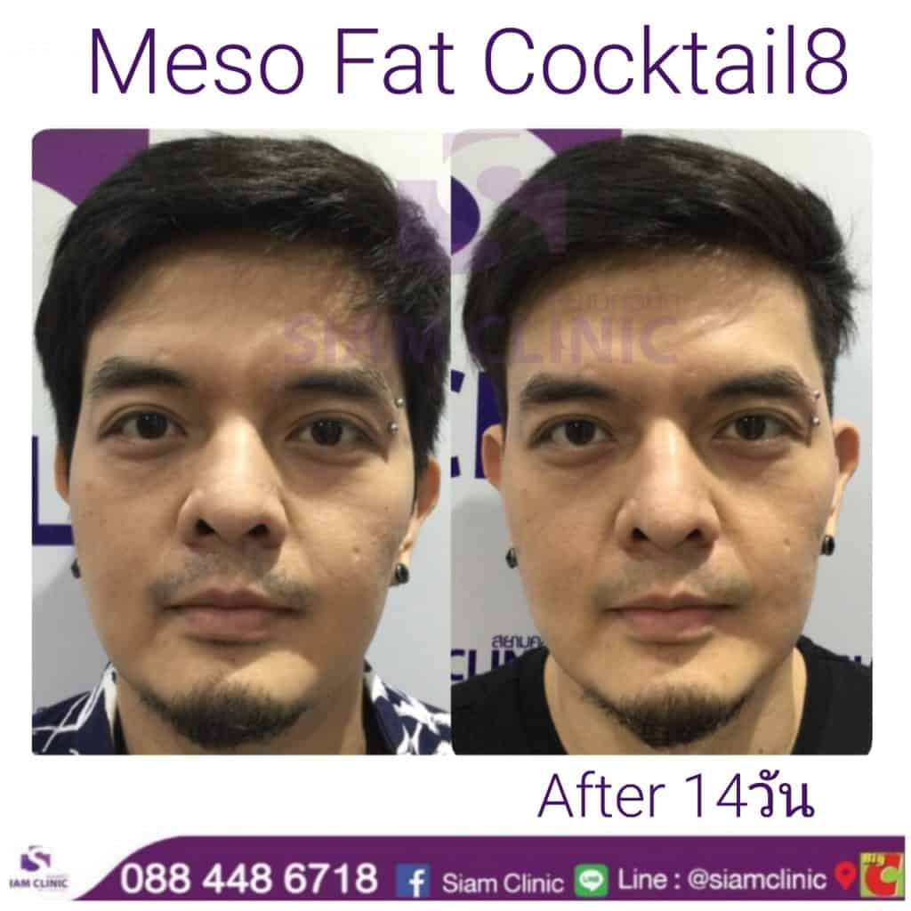 เมโสแฟต Meso Fat