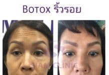 รีวิวโบท็อกซ์