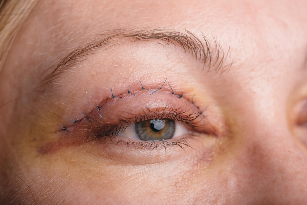 blepharoplasty-upper-eyelid-operation-that-removes-excess-ugly-skin-eyelids-eyes-photos-show-seams-this-is-third-day-after-operation