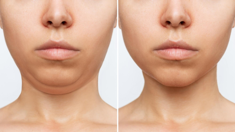 liposuction-double-chin-woman-s-face-with-chin-before-after-cosmetic-plastic-surgery