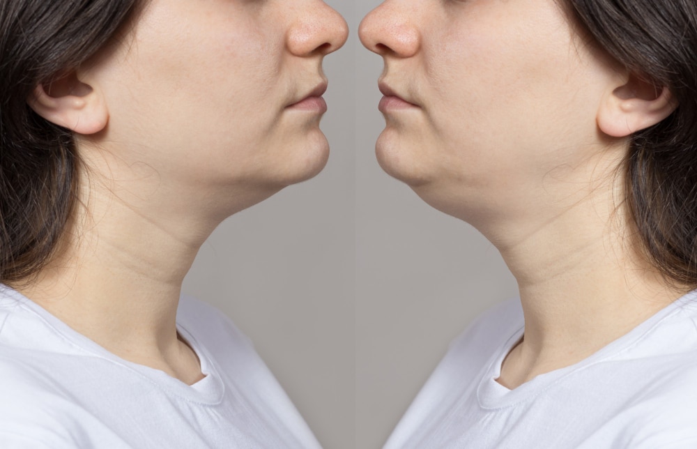 woman-with-double-chin-before-after-treatment