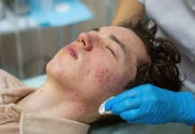 รู้หรือไม่! สิวสเตียรอยด์ และสิวฮอร์โมนต่างกันอย่างไร?