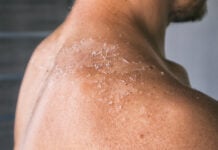 ผิวไหม้แดด ปัญหาที่ไม่ควรละเลย สาเหตุมาจากอะไร