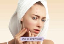What are blind pimples?