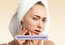 สิวไม่มีหัวเกิดจากอะไร (Blind Pimples): สิวที่เกิดจากการอักเสบลึกใต้ผิวหนัง สิวอักเสบไม่มีหัวเกิดจากอะไร