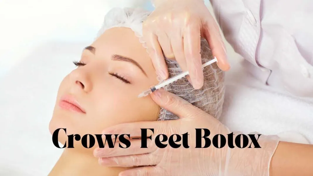 crows-feet-botox Smooth out fine lines around your eyes with crows feet Botox. Learn how it works, what results to expect, cost, safety, and FAQs—all in one easy guide.