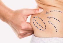 Considering liposuction in Thailand? Discover how this popular procedure works, the benefits, risks, and why Siam Clinic in Phuket is trusted for body contouring.