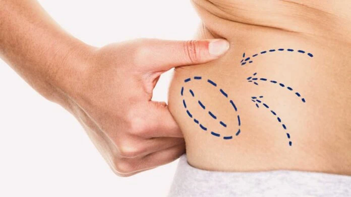 liposuction-thailand-siam-clinic Considering liposuction in Thailand? Discover how this popular procedure works, the benefits, risks, and why Siam Clinic in Phuket is trusted for body contouring.